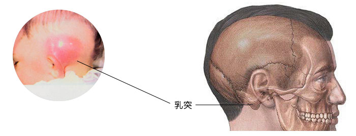 乳突切除術