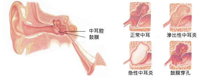 中耳炎