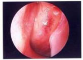 Allergic rhinitis