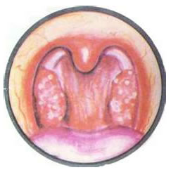 Tonsillitis
