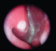 Sinusitis