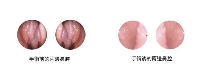 鼻瘜肉