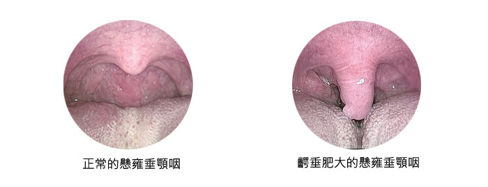 懸雍垂顎咽成形術