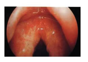 Pharyngitis 